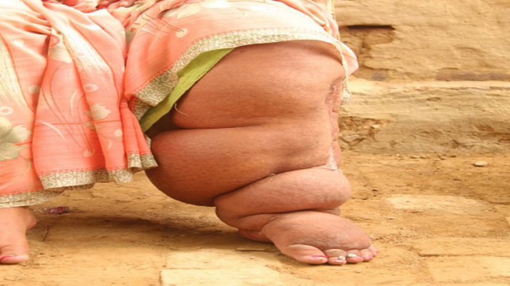 Inequality thrives: Women carry the weight of Lymphatic Filariasis more than men